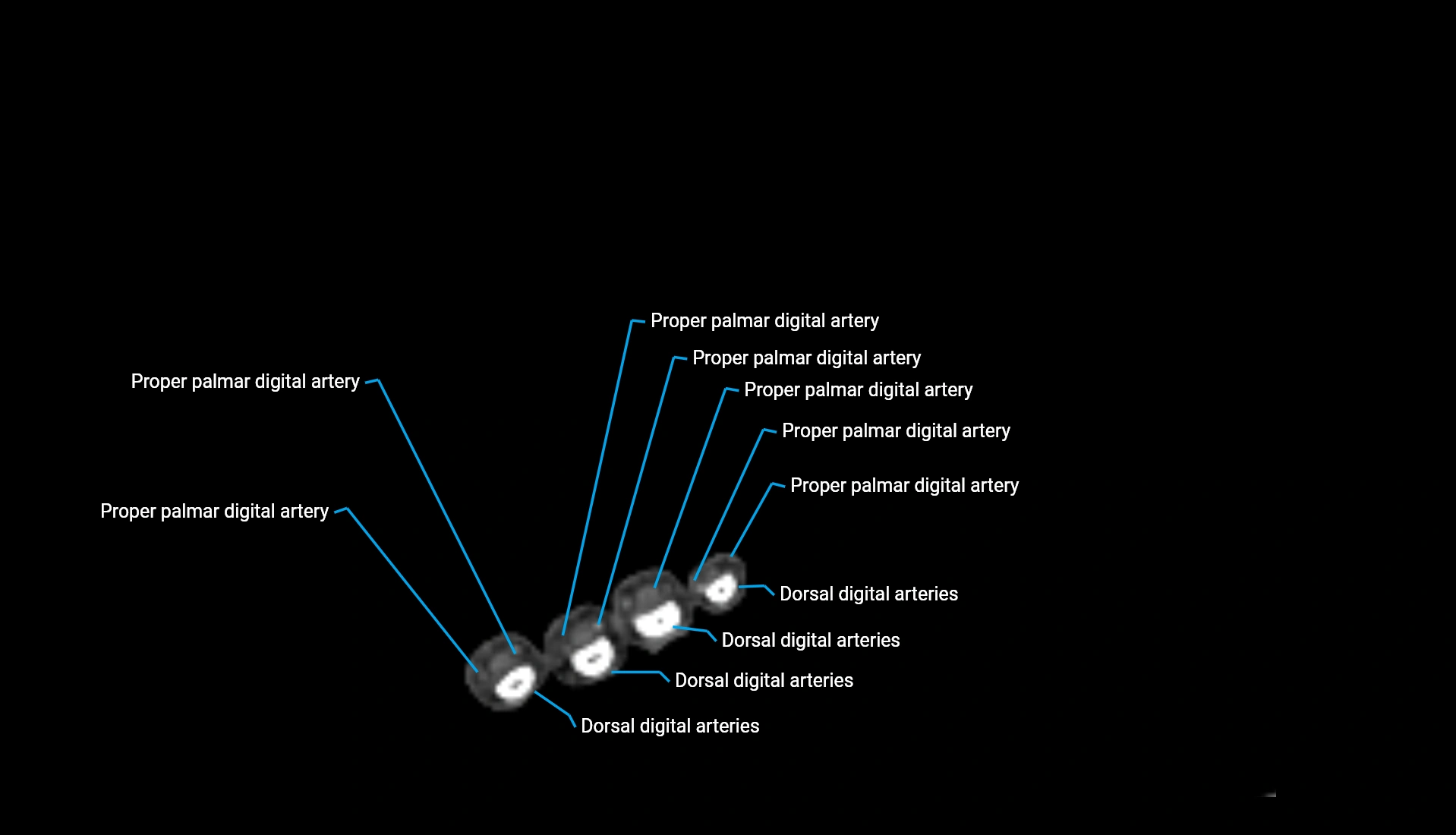 CTA upper limb axial cross sectional anatomy labelled image 30 (2).webp